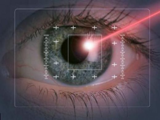 Lazer Göz Ameliyatı Zararları