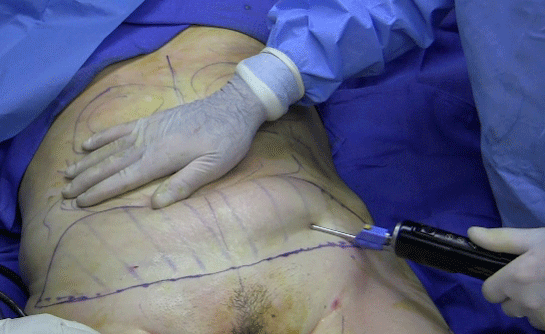 Liposuction Zararlar